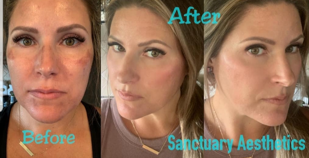 hyperpigmentation, sun spots, age spots, sun damage, peels, microdermabrasion, PCA peel, best esthetician in Kansas City, best esthetician in Overland park